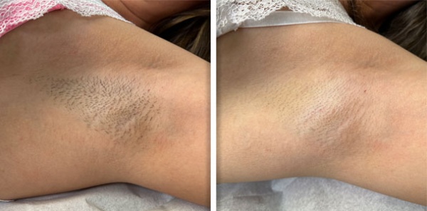 hair_removal_avalanche